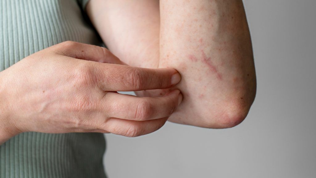 tratament-naturist-arsuri-piele-1