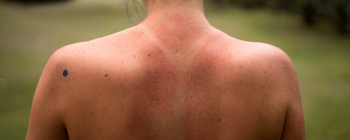 tratament-naturist-arsuri-piele