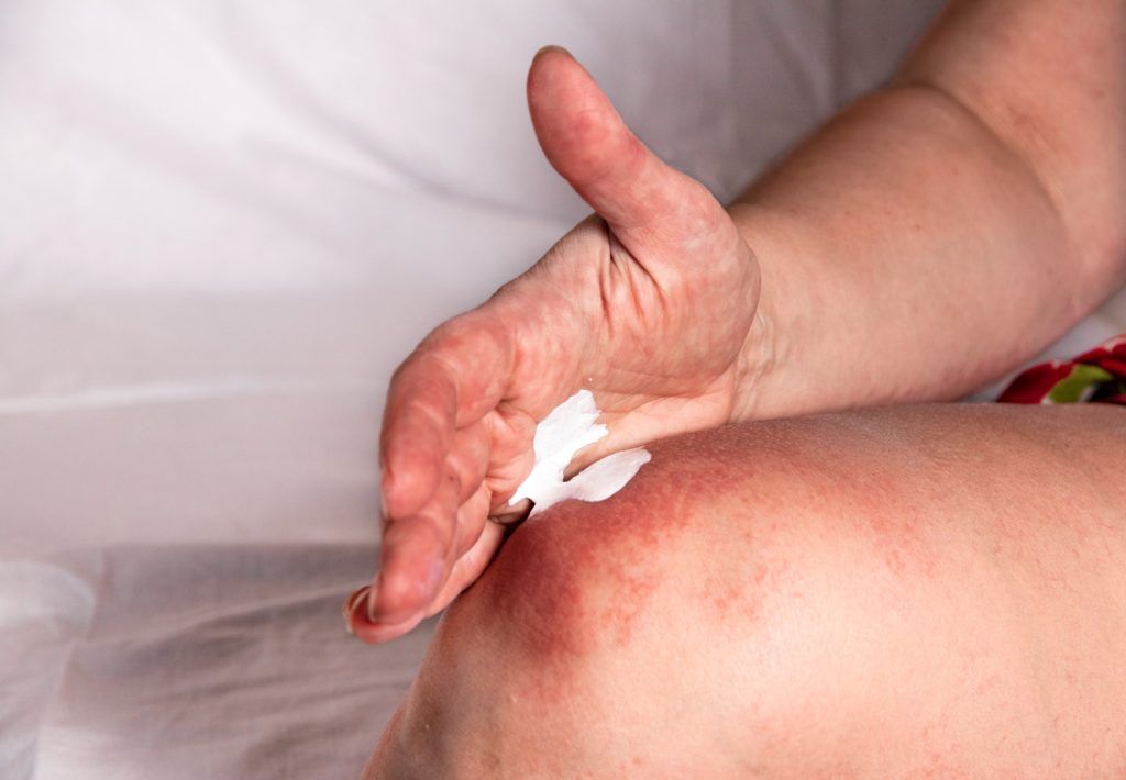 tratament-naturist-arsuri-piele-8