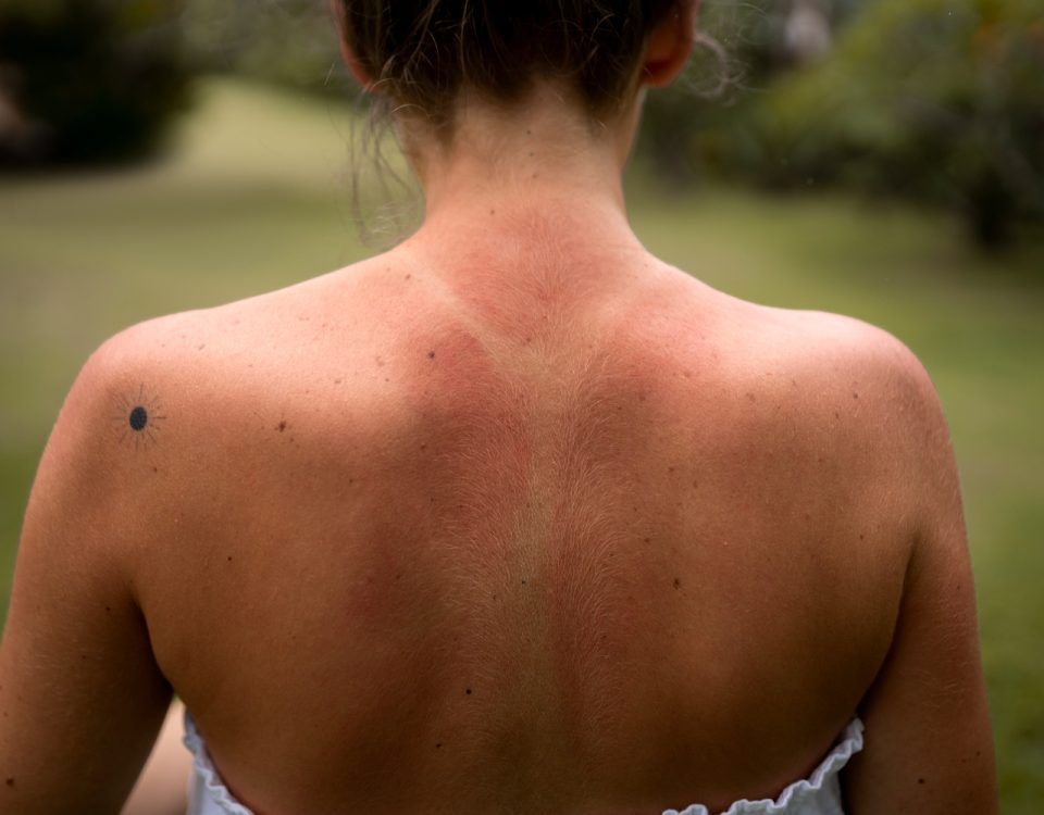 tratament-naturist-arsuri-piele